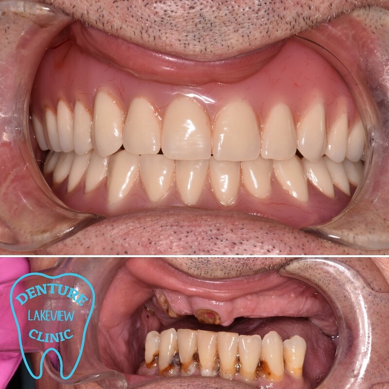 Same-Day Dentures Service