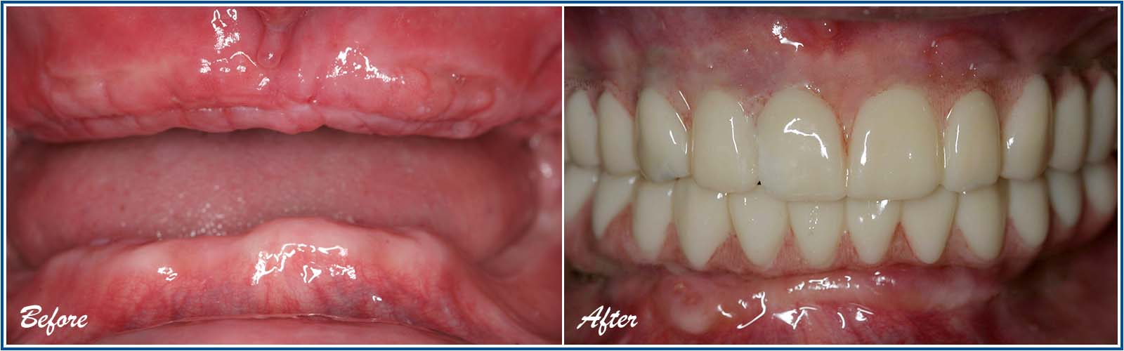 Same-Day Dentures Service
