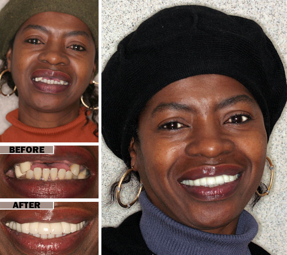 Same-Day Dentures Service