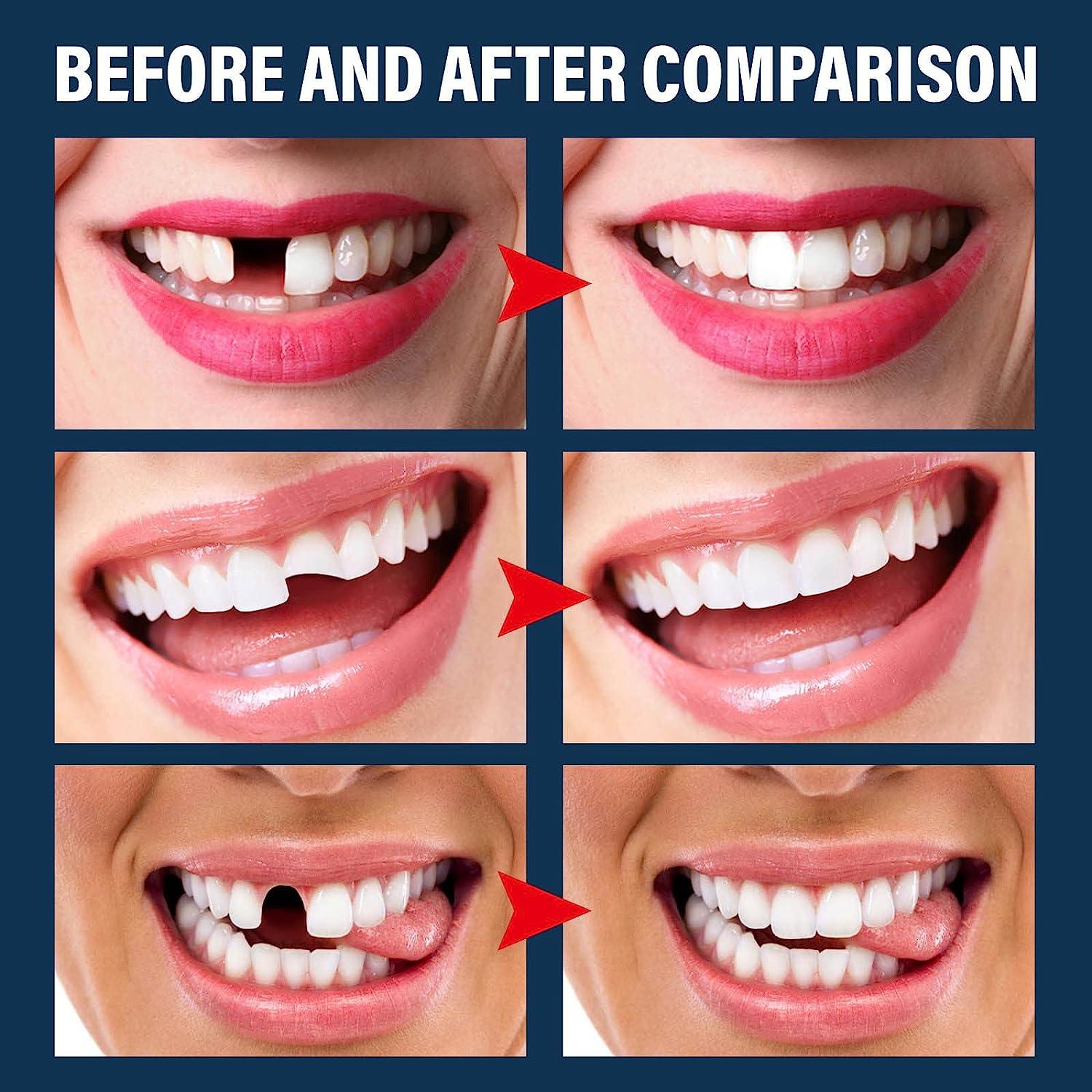 Denture Repair Kits
