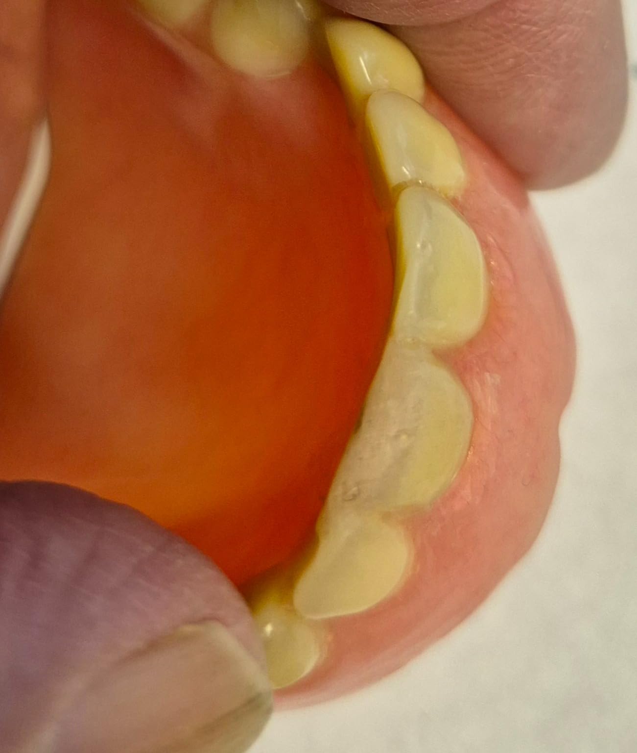 Denture Repair Kits