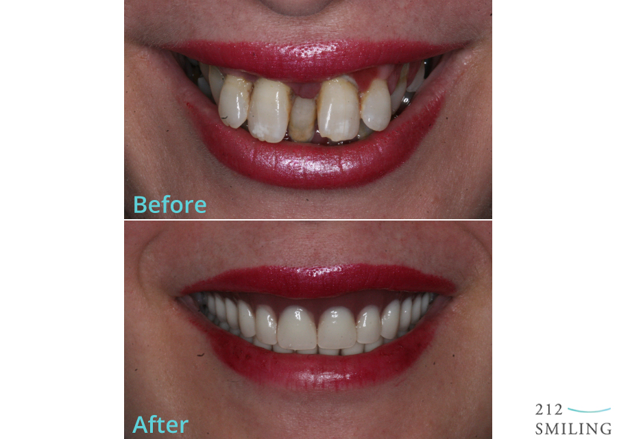Same-Day Dentures in North Charleston: A Step-by-Step Guide