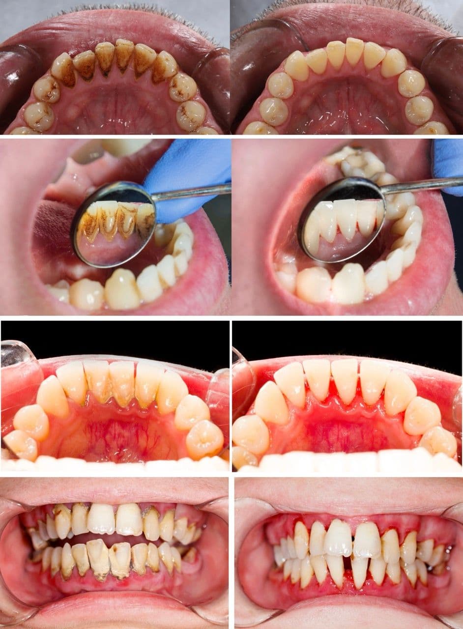 Affordable Dentures