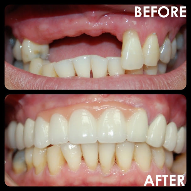 Same-Day Dentures Service