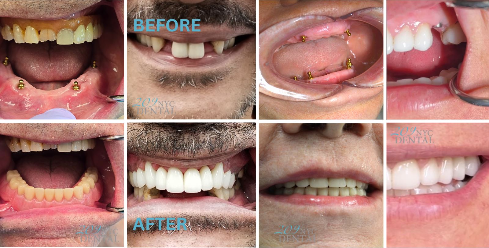 Same-Day Dentures Service