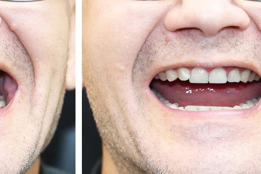 confident denture wearer