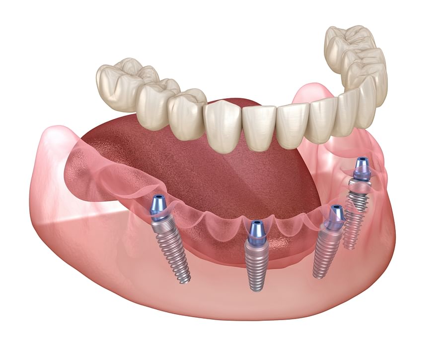Illustration of denture implants for oral health