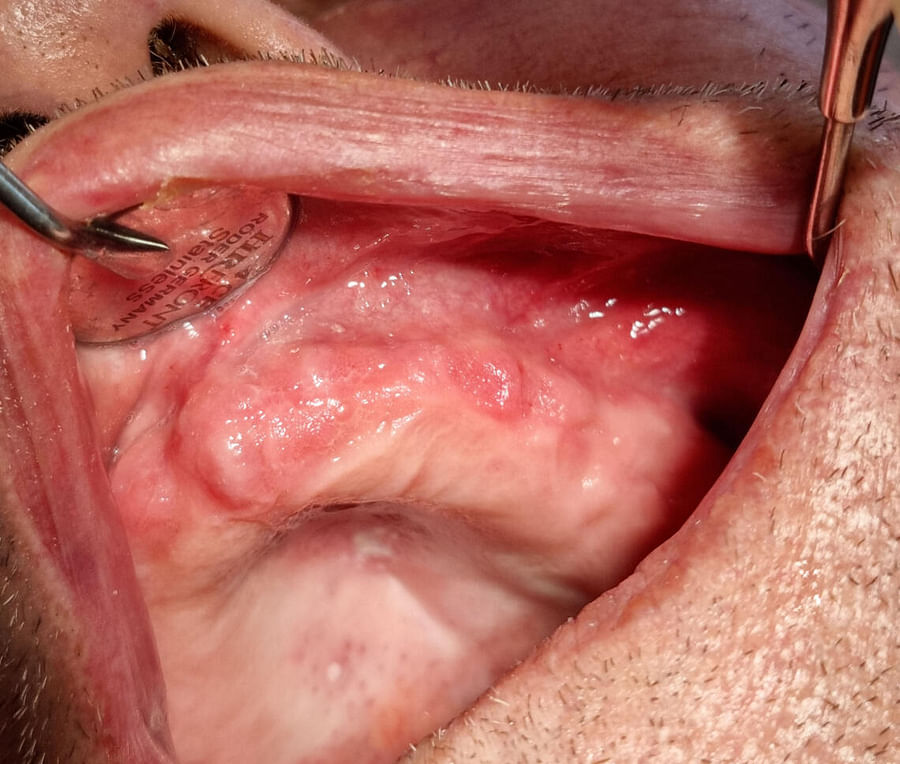 Close-up view of a denture showing signs of Stomatitis